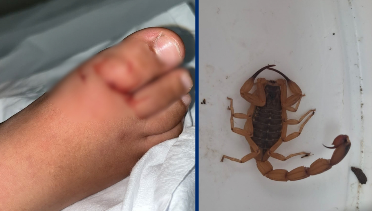 Em cinco dias, Capivari tem duas crianças picadas por escorpiões em creche