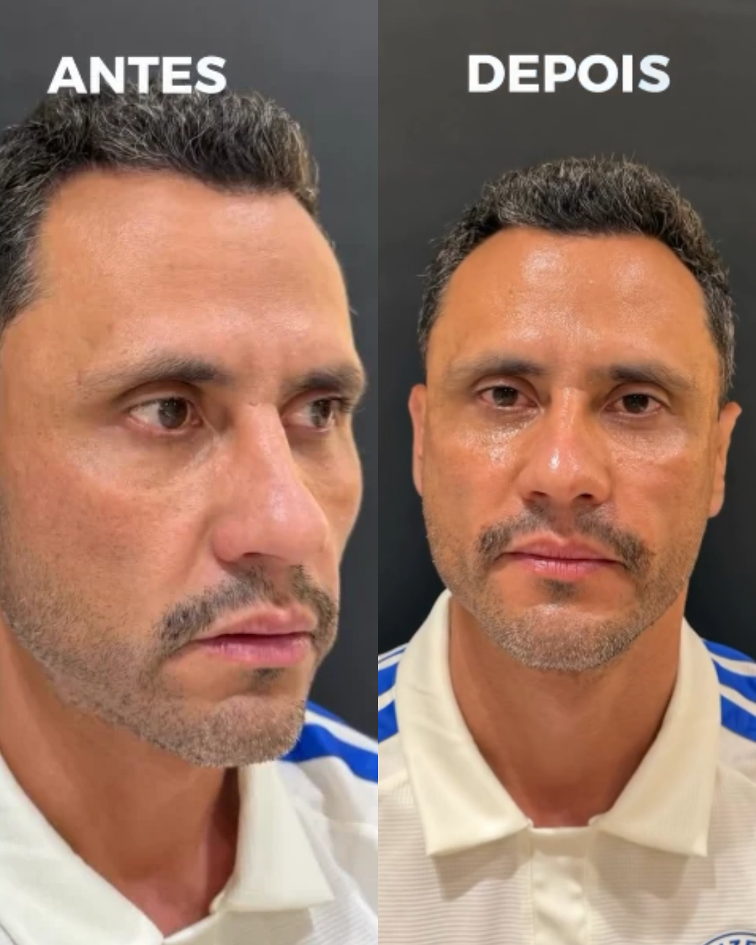 Após ser eleito governador, Cleitinho faz harmonização facial